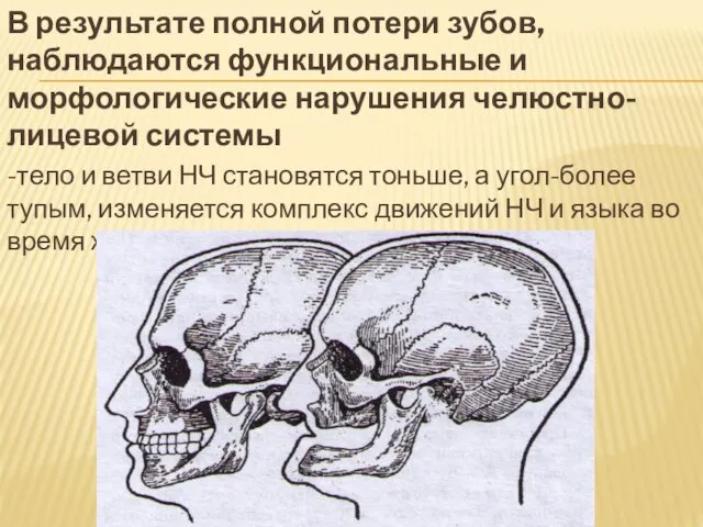 В результате полной потери зубов, наблюдаются функциональные и морфологические нарушения челюстно-лицевой