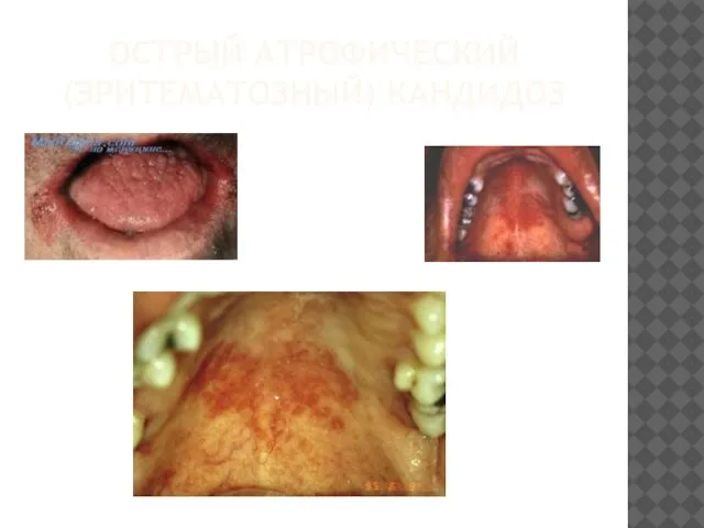 ОСТРЫЙ АТРОФИЧЕСКИЙ (ЭРИТЕМАТОЗНЫЙ) КАНДИДОЗ