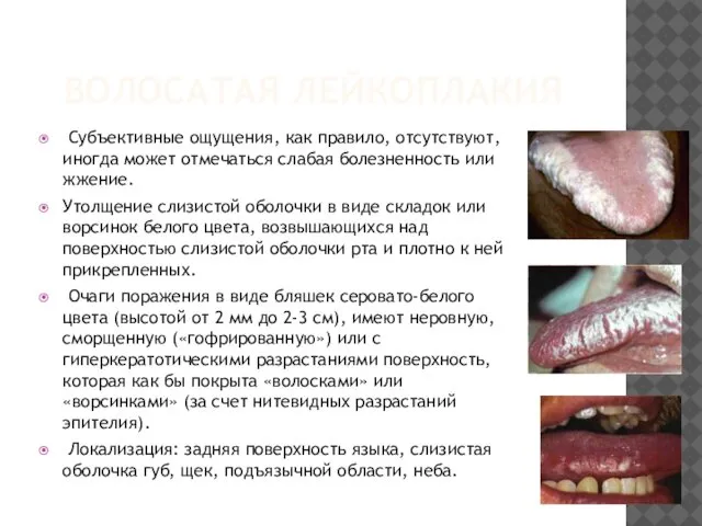 ВОЛОСАТАЯ ЛЕЙКОПЛАКИЯ Субъективные ощущения, как правило, отсутствуют, иногда может отмечаться слабая