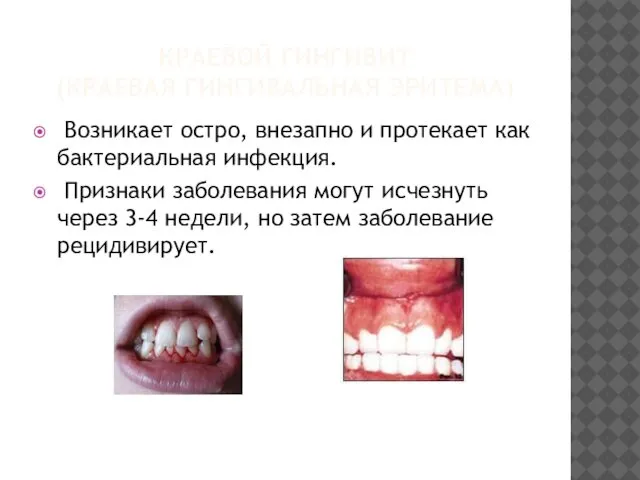 КРАЕВОЙ ГИНГИВИТ (КРАЕВАЯ ГИНГИВАЛЬНАЯ ЭРИТЕМА) Возникает остро, внезапно и протекает как