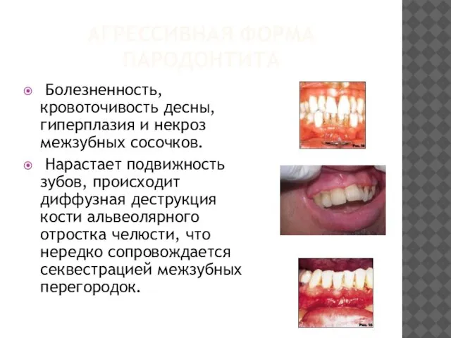 АГРЕССИВНАЯ ФОРМА ПАРОДОНТИТА Болезненность, кровоточивость десны, гиперплазия и некроз межзубных сосочков.