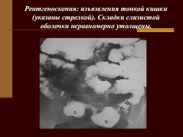 Рентгеноскопия: изъязвления тонкой кишки (указаны стрелкой). Складки слизистой оболочки неравномерно утолщены.