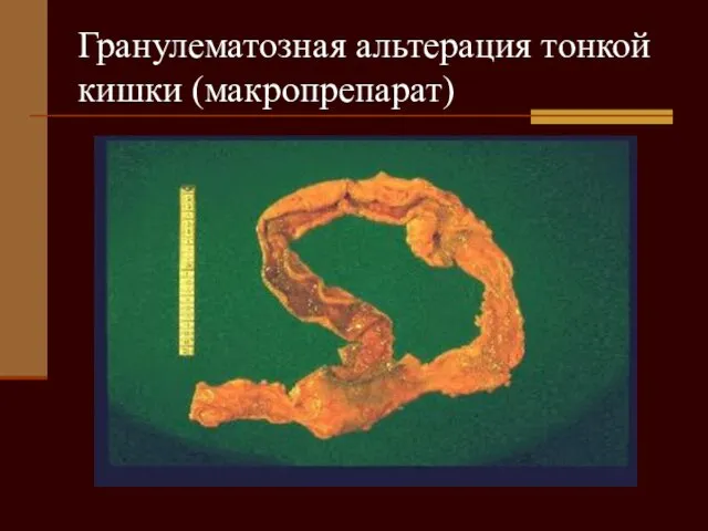 Гранулематозная альтерация тонкой кишки (макропрепарат)