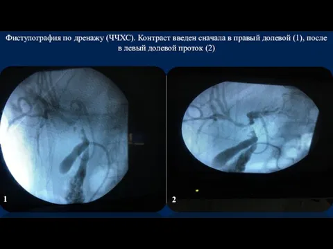 Фистулография по дренажу (ЧЧХС). Контраст введен сначала в правый долевой (1),