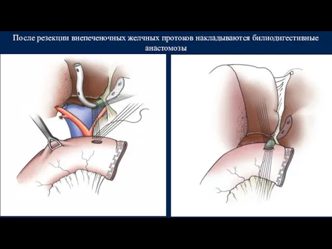 После резекции внепеченочных желчных протоков накладываются билиодигестивные анастомозы