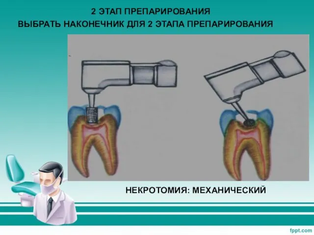 2 ЭТАП ПРЕПАРИРОВАНИЯ ВЫБРАТЬ НАКОНЕЧНИК ДЛЯ 2 ЭТАПА ПРЕПАРИРОВАНИЯ НЕКРОТОМИЯ: МЕХАНИЧЕСКИЙ