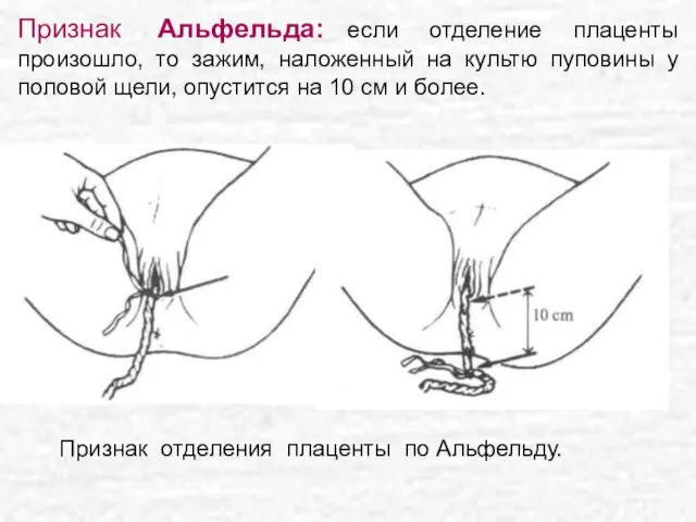 Признак Альфельда: если отделение плаценты произошло, то зажим, наложенный на культю