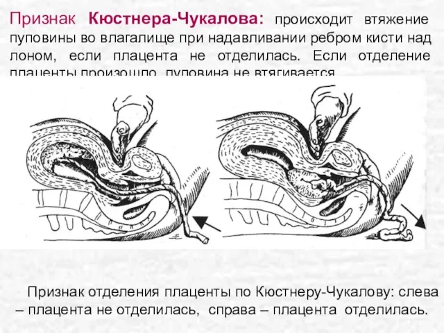 Признак Кюстнера-Чукалова: происходит втяжение пуповины во влагалище при надавливании ребром кисти