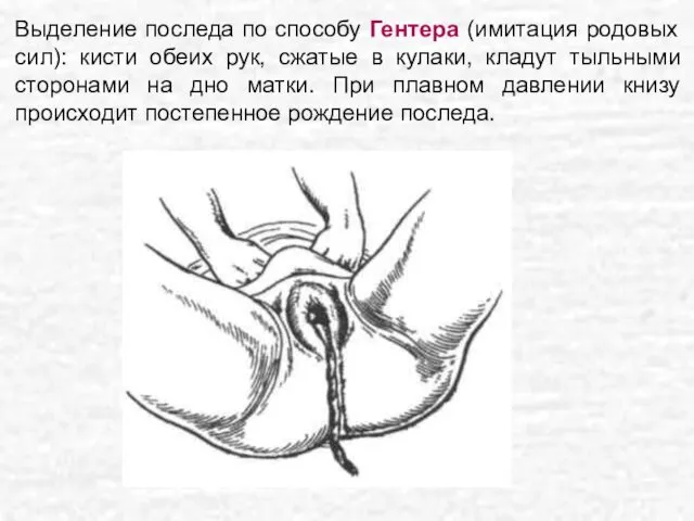 Выделение последа по способу Гентера (имитация родовых сил): кисти обеих рук,