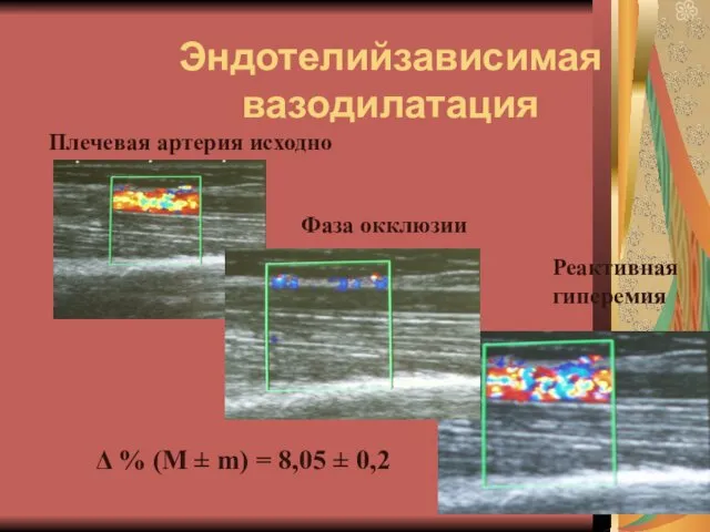 Эндотелийзависимая вазодилатация Плечевая артерия исходно Фаза окклюзии Реактивная гиперемия Δ %