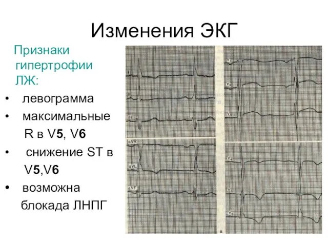 Изменения ЭКГ Признаки гипертрофии ЛЖ: левограмма максимальные R в V5, V6