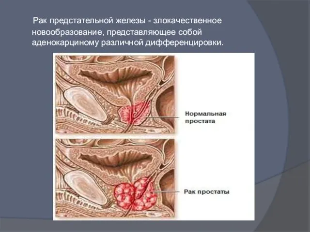 Рак предстательной железы - злокачественное новообразование, представляющее собой аденокарциному различной дифференцировки.