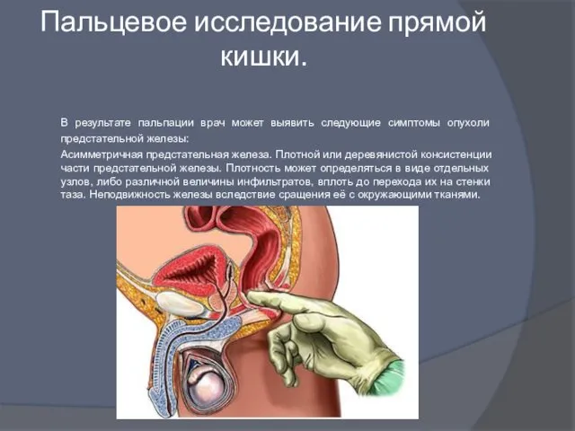 Пальцевое исследование прямой кишки. В результате пальпации врач может выявить следующие