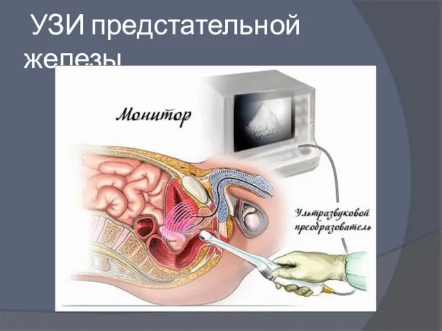 УЗИ предстательной железы