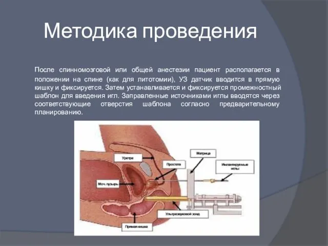 Методика проведения После спинномозговой или общей анестезии пациент располагается в положении