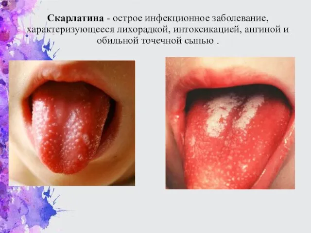 Скарлатина - острое инфекционное заболевание, характеризующееся лихорадкой, интоксикацией, ангиной и обильной точечной сыпью .