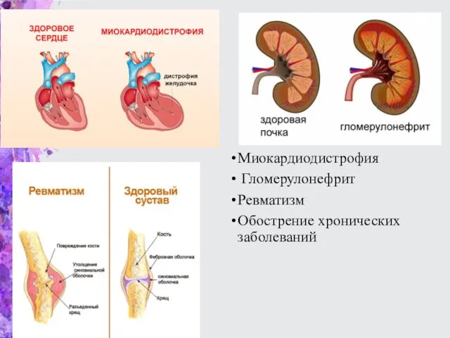 Миокардиодистрофия Гломерулонефрит Ревматизм Обострение хронических заболеваний