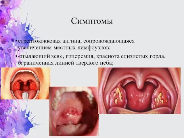 Симптомы стрептококковая ангина, сопровождающаяся увеличением местных лимфоузлов; «пылающий зев», гиперемия, краснота