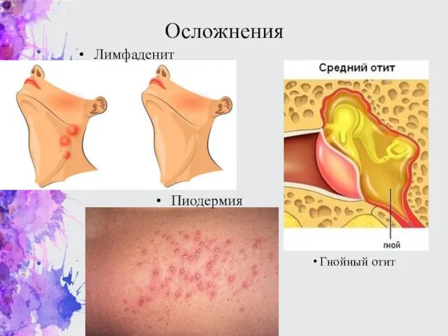 Осложнения Гнойный отит Пиодермия Лимфаденит