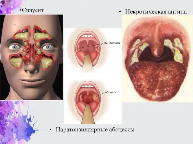 Синусит Некротическая ангина Паратонзиллярные абсцессы