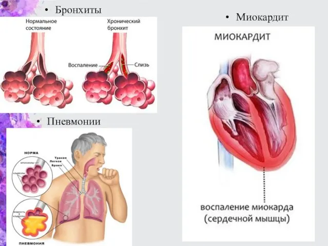 Пневмонии Бронхиты Миокардит