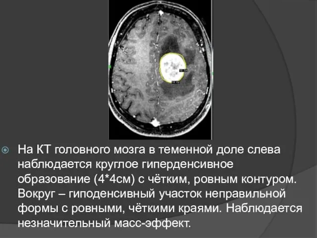 На КТ головного мозга в теменной доле слева наблюдается круглое гиперденсивное