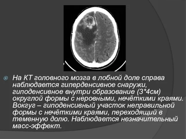 На КТ головного мозга в лобной доле справа наблюдается гиперденсивное снаружи,