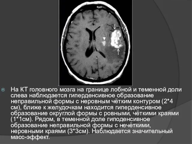 На КТ головного мозга на границе лобной и теменной доли слева