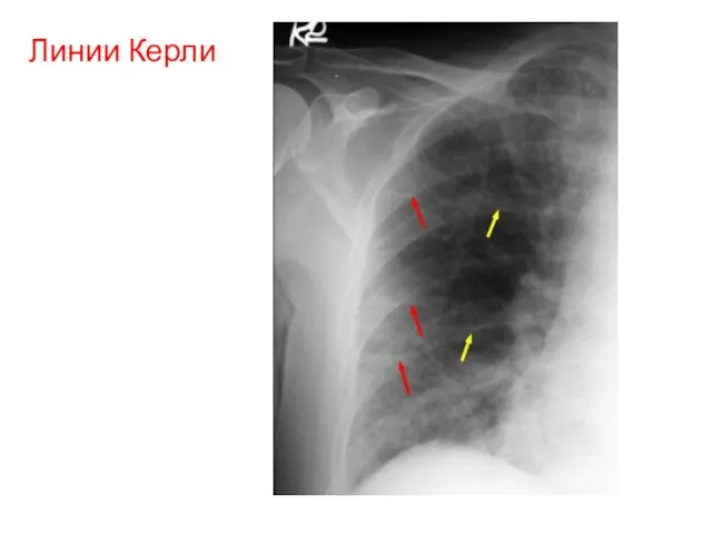 Линии Керли