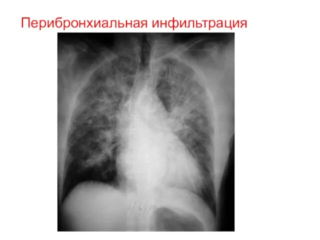 Перибронхиальная инфильтрация