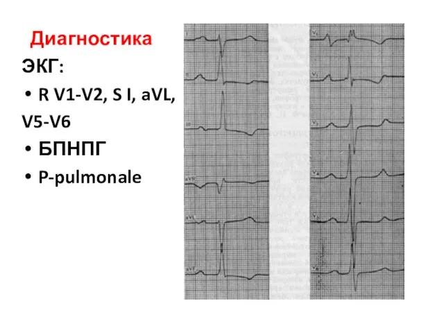 Диагностика ЭКГ: R V1-V2, S I, aVL, V5-V6 БПНПГ P-pulmonale
