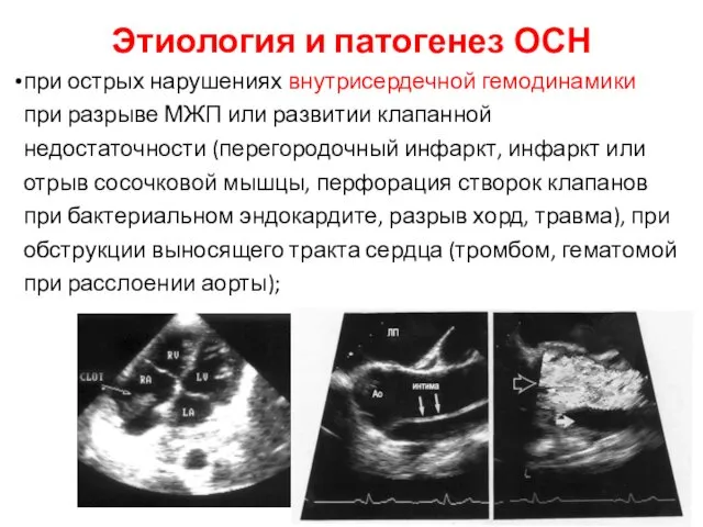 Этиология и патогенез ОСН при острых нарушениях внутрисердечной гемодинамики при разрыве