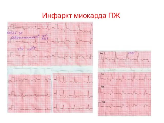 Инфаркт миокарда ПЖ