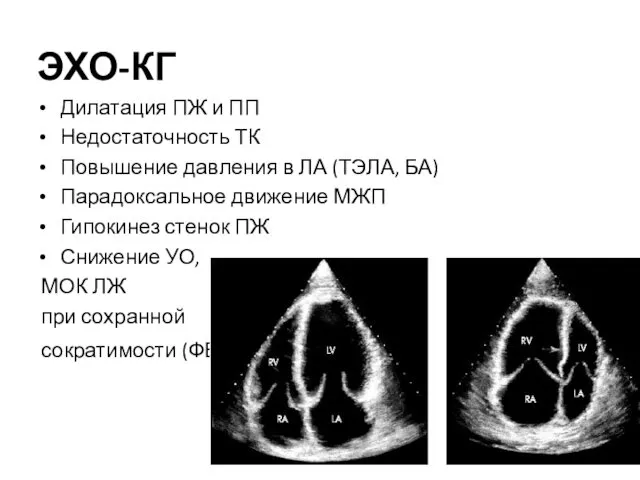 ЭХО-КГ Дилатация ПЖ и ПП Недостаточность ТК Повышение давления в ЛА