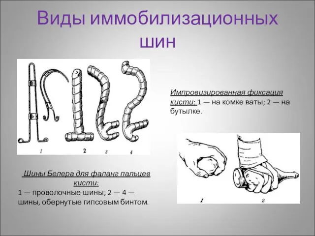 Виды иммобилизационных шин Шины Белера для фаланг пальцев кисти: 1 —