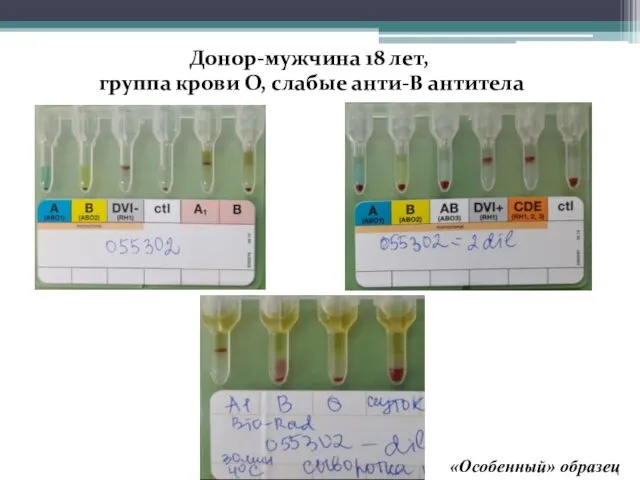 Донор-мужчина 18 лет, группа крови О, слабые анти-В антитела «Особенный» образец