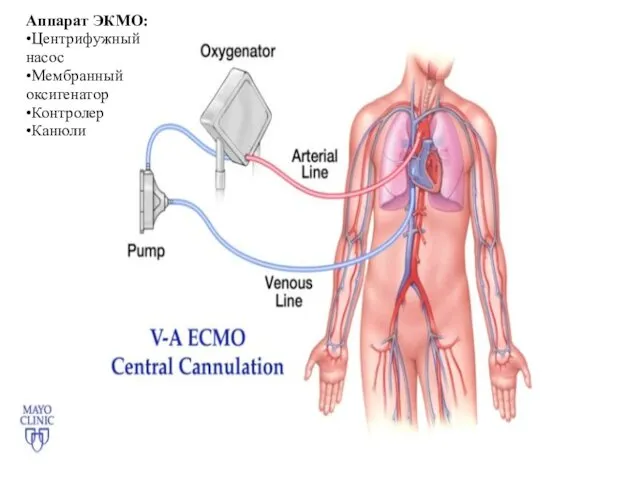 Аппарат ЭКМО: •Центрифужный насос •Мембранный оксигенатор •Контролер •Канюли