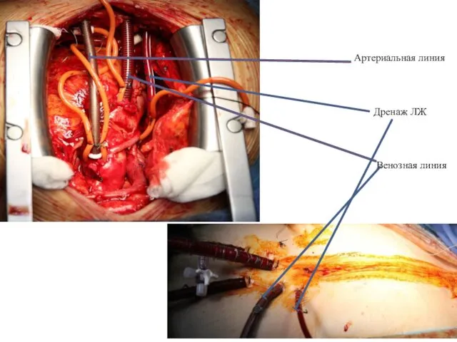 Артериальная линия Дренаж ЛЖ Венозная линия