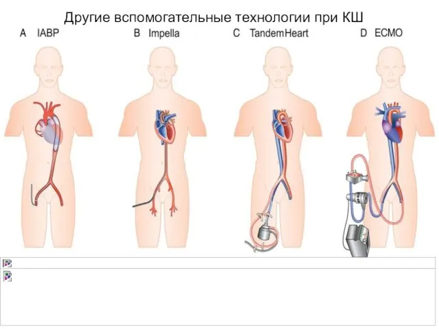 Другие вспомогательные технологии при КШ