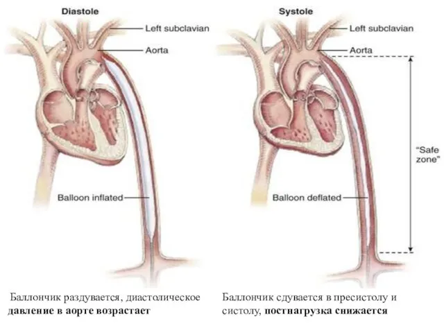 Баллончик сдувается в пресистолу и систолу, постнагрузка снижается Баллончик раздувается, диастолическое давление в аорте возрастает