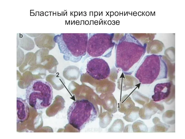 Бластный криз при хроническом миелолейкозе