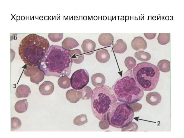 Хронический миеломоноцитарный лейкоз