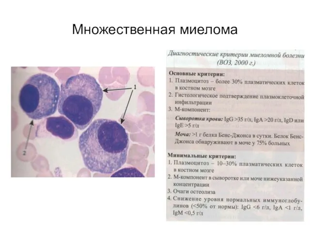 Множественная миелома