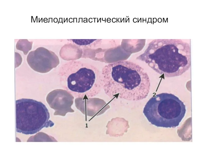 Миелодиспластический синдром