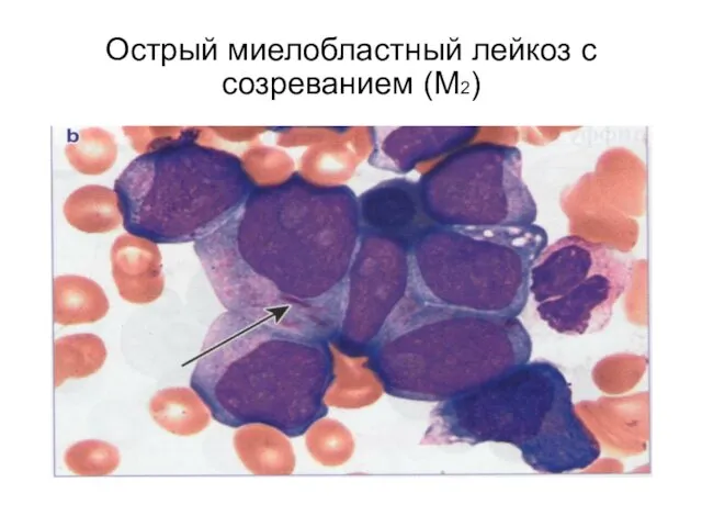 Острый миелобластный лейкоз с созреванием (М2)