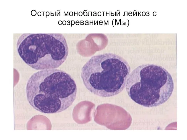 Острый монобластный лейкоз с созреванием (М5в)