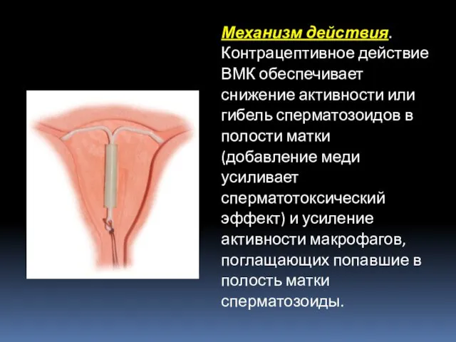 Механизм действия. Контрацептивное действие ВМК обеспечивает снижение активности или гибель сперматозоидов