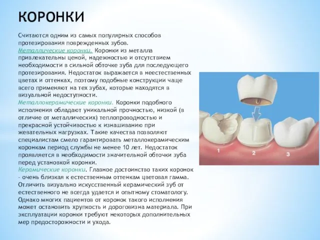 КОРОНКИ Считаются одним из самых популярных способов протезирования поврежденных зубов. Металлические