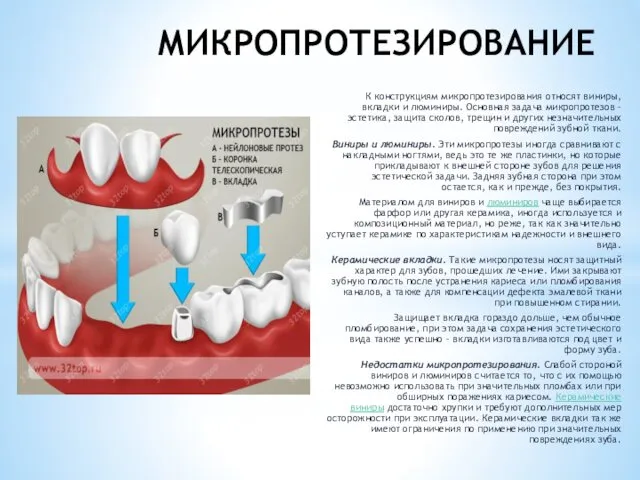 МИКРОПРОТЕЗИРОВАНИЕ К конструкциям микропротезирования относят виниры, вкладки и люминиры. Основная задача