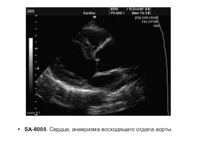 SA-8000. Сердце, аневризма восходящего отдела аорты.